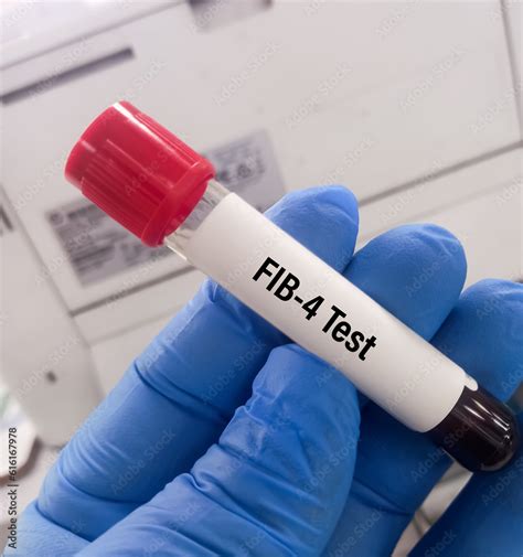 fib 4 blood test bottle|fib 4 for fibrosis.